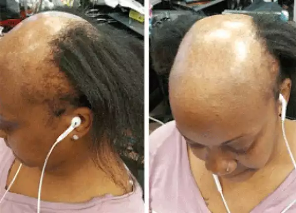 Amazing! See how hairstylist transformed balding woman